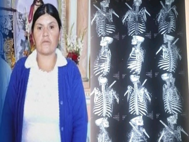 Huaraz: Madre lucha por su vida por fierro incrustado cerca a su corazón